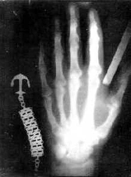 Первый снимок в X–лучах, левая рука Вильгельма Рёнтгена, 1895 