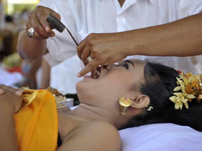 6. Спиливание зубов на Бали