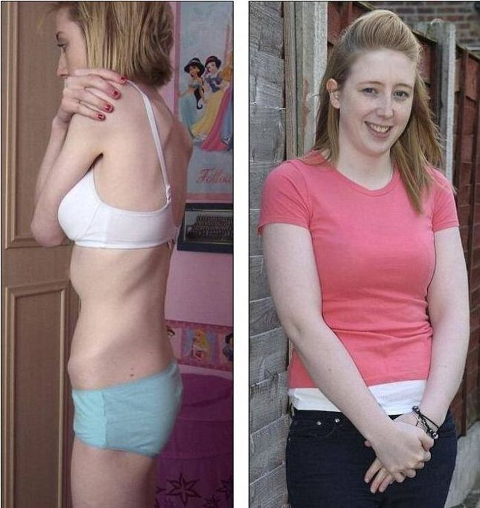 Жертвы анорексии до и после выздоровления