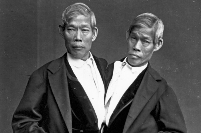 10 удивительных историй самых известных сиамских близнецов