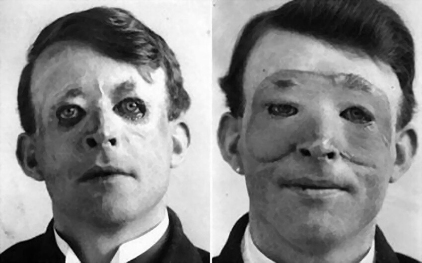 15. Первый в истории человек, которому пересадили кожу. 1917 год.