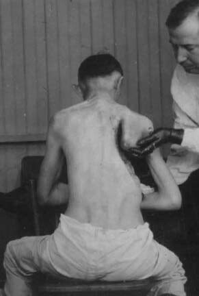 4. Фотография времён Первой мировой войны, демонстрирующая удаление нескольких рёбер во время лечения эмпиемы плевры.