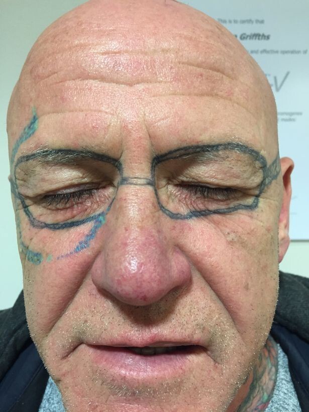 Пожилой британец 2 года удалял очки-тату, которые ему «набили», пока он спал пьяный