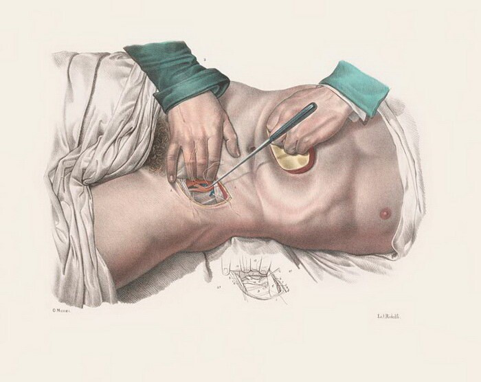 Как делали хирургические операции в начале прошлого века
