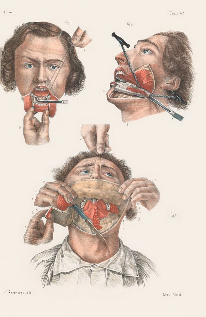 Как делали хирургические операции в начале прошлого века