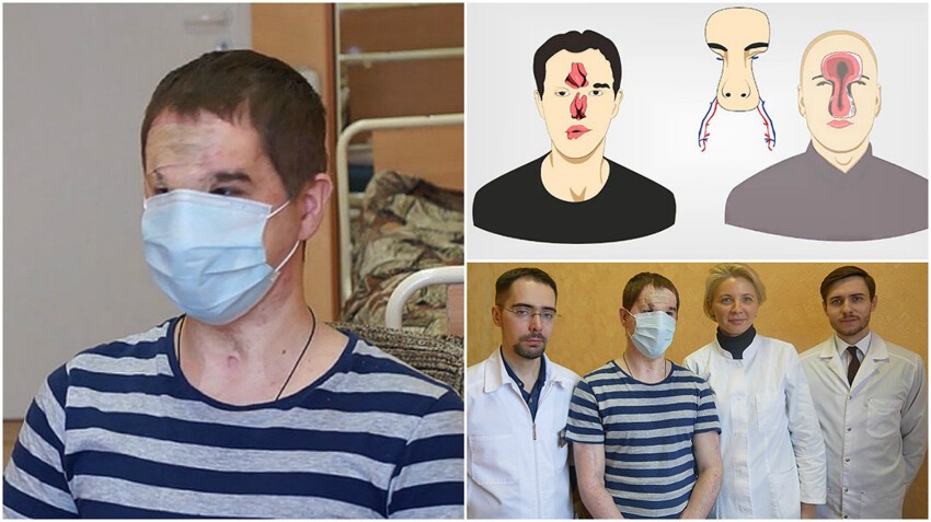 Первая операция по пересадке лица в России