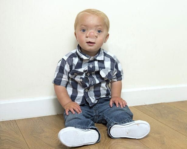 Реальный Пиноккио: мальчик родился с частью мозга в носу