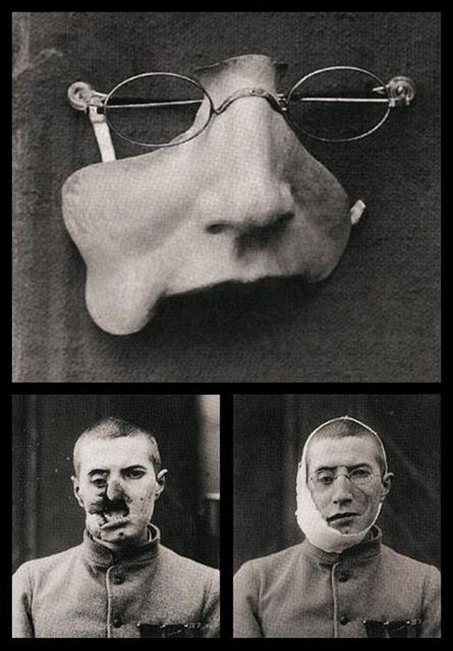 Лицевой протез для раненого солдата Первой мировой