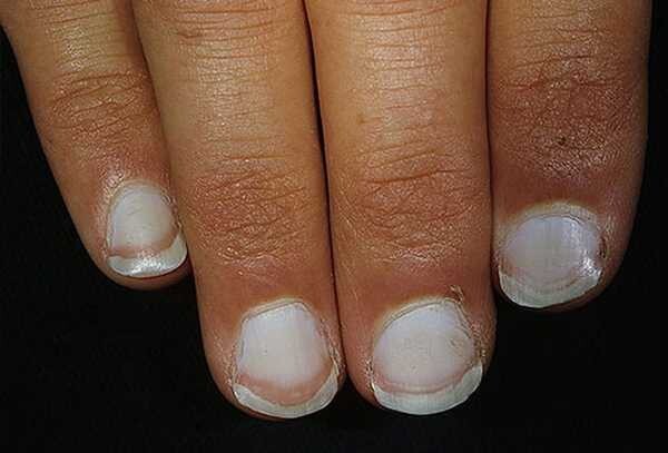 Onicomicoza - infectia fungica a unghiei