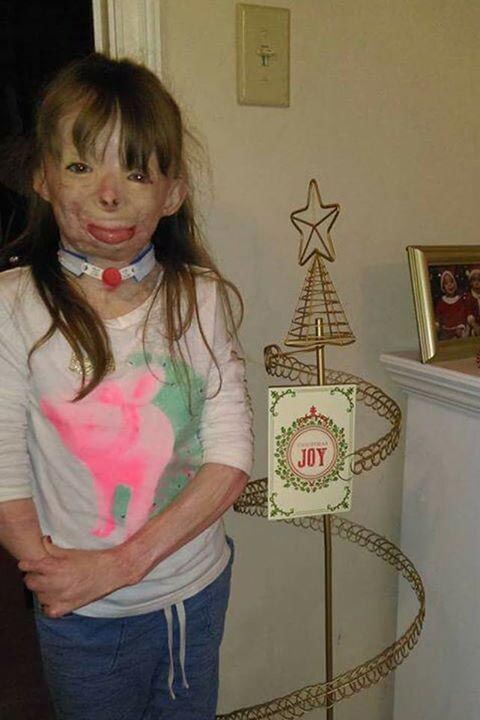 Обгоревшая девочка, потерявшая семью в пожаре, получила миллион рождественских открыток
