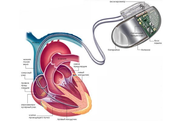 Кардиостимулятор.