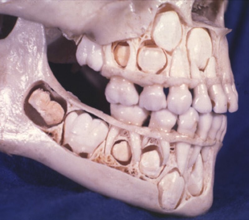 8. Так выглядит череп ребенка до того, как у него выпадают молочные зубы: