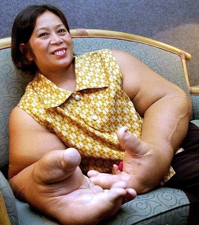 Тайская женщина с самыми большими руками в мире, весом в 19 килограмм