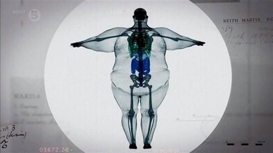 3. Рентгеновский снимок 400-килограммового человека