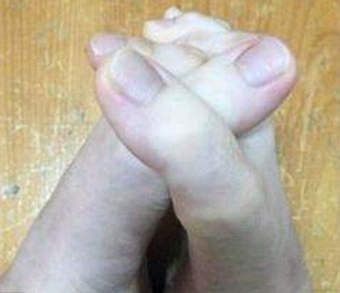   Тайванка удивила снимком аномально длинных пальцев на ногах 