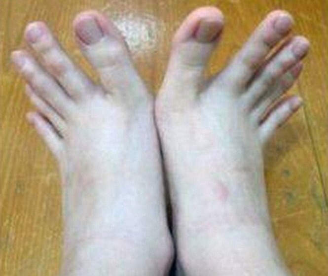   Тайванка удивила снимком аномально длинных пальцев на ногах 