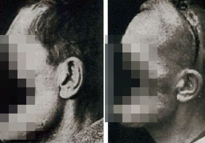 Реконструкция лица на заре пластической хирургии