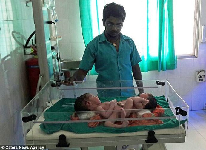 В Индии родились сиамские близнецы с одной парой ног 