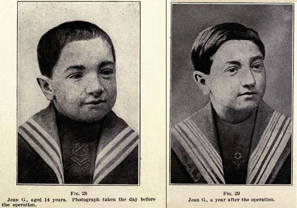 14-летний пациент Воронова до (на фото слева) и после операции (на фото справа)