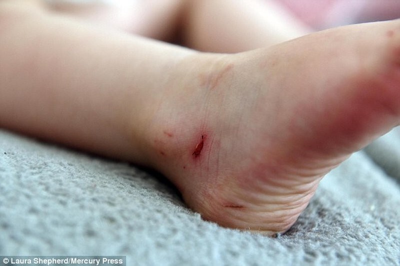 Всего за 30 минут босоножки счесали ноги ребенка в кровь
