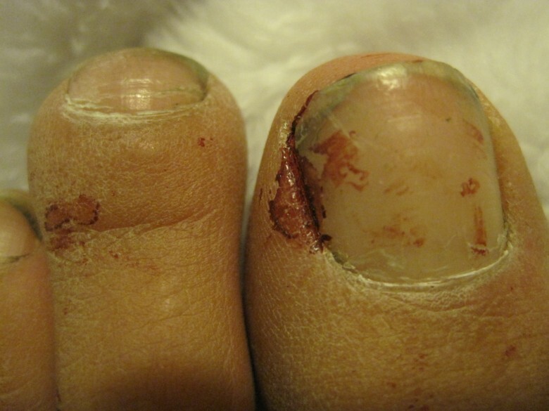 6. Отвратительные ногти на ногах
