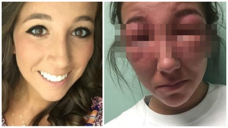 Пользователи Твиттера прикалываются над фото девушки, которой в глаза попал ядовитый плющ