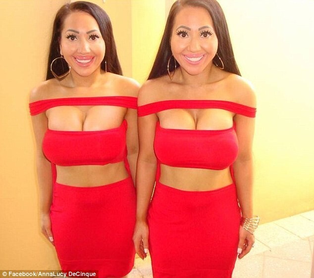 Самым похожим в мире близнецам хирурги отказались сделать общую грудь