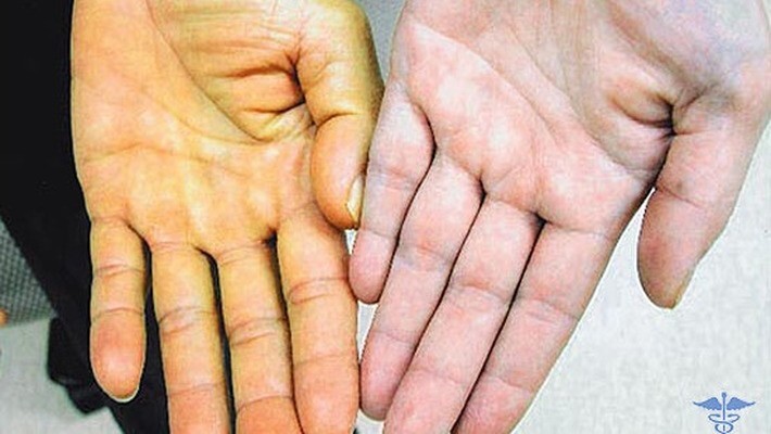 Желтушность кожных покровов при гепатите