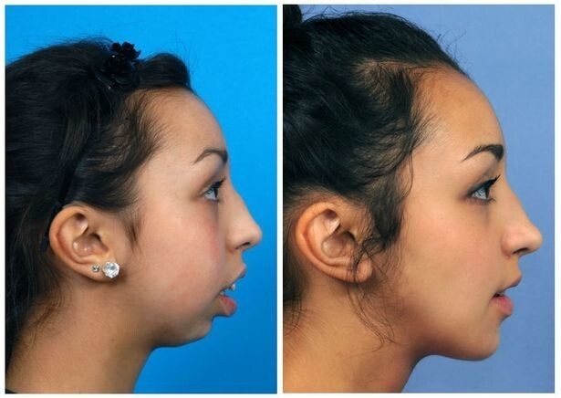 Хирург поправил ей форму челюсти: просто невероятное преображение