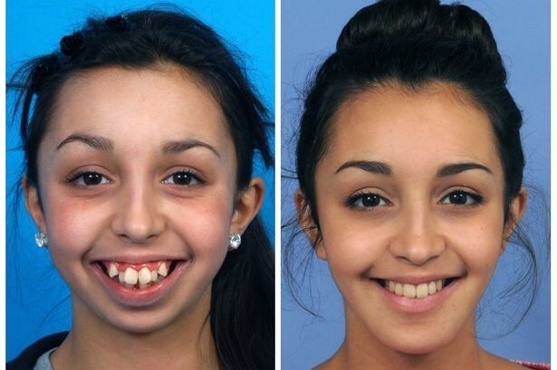 Хирург поправил ей форму челюсти: просто невероятное преображение