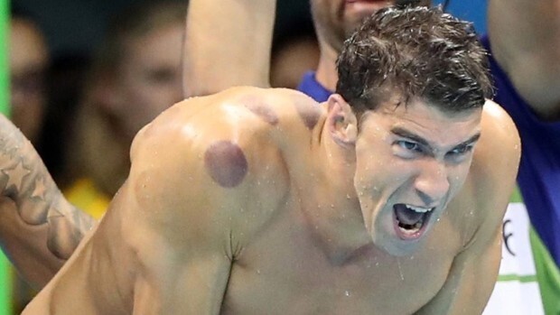 Наверняка кто-нибудь из вас, смотря Олимпиаду, заметил круглые синяки на плече у Майкла Фелпса