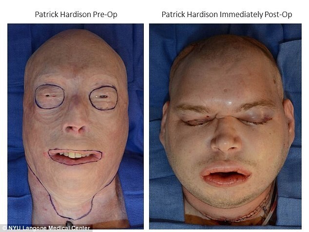 Патрик до и сразу же после пересадки 