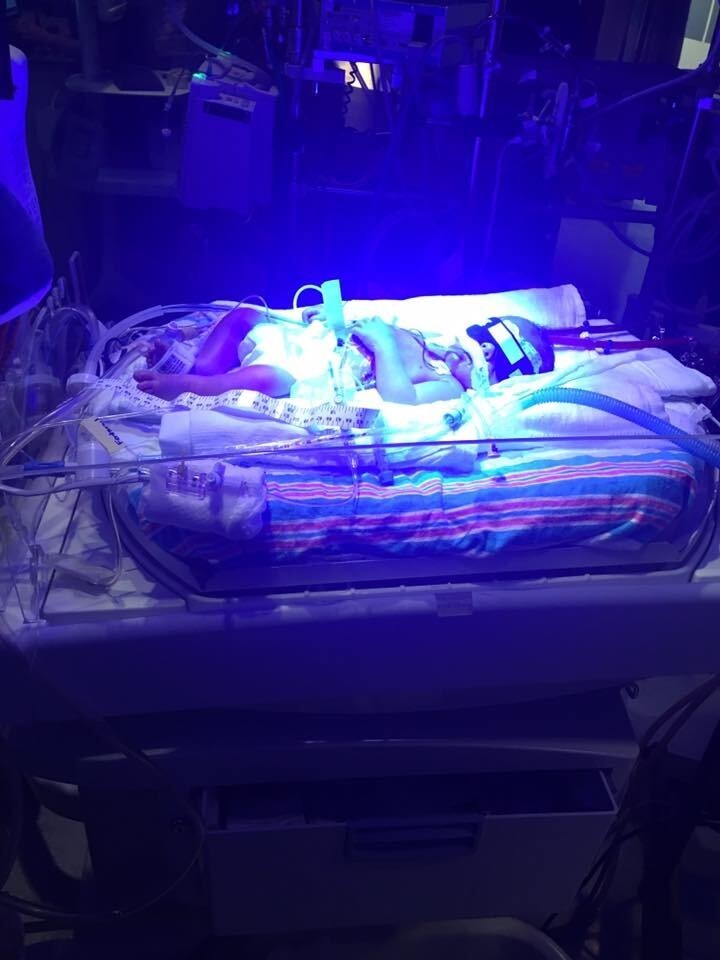 Душераздирающее фото новорожденного ребёнка, прощающегося со своим близнецом