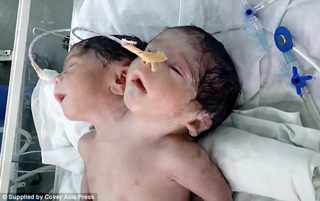 Ребенок в Индии, родившийся с двумя головами, прожил всего 32 часа после родов
