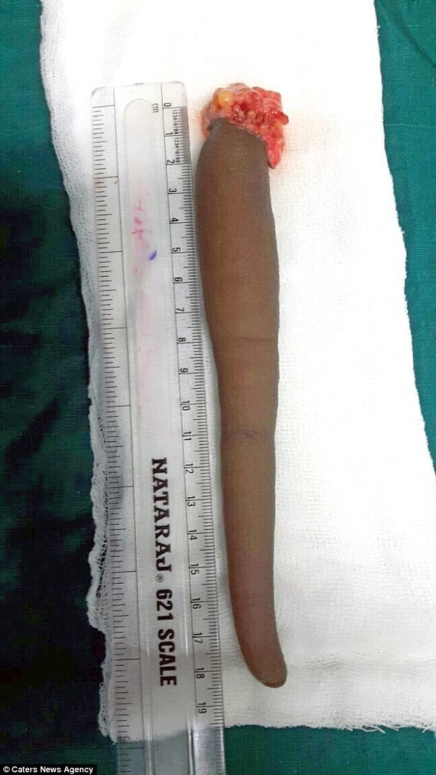 Индийские хирурги удалили парню 18-сантиметровый хвост