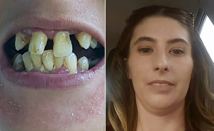 Женщине удалили 20 зубов, чтобы избавить её от чудовищно кривых зубов