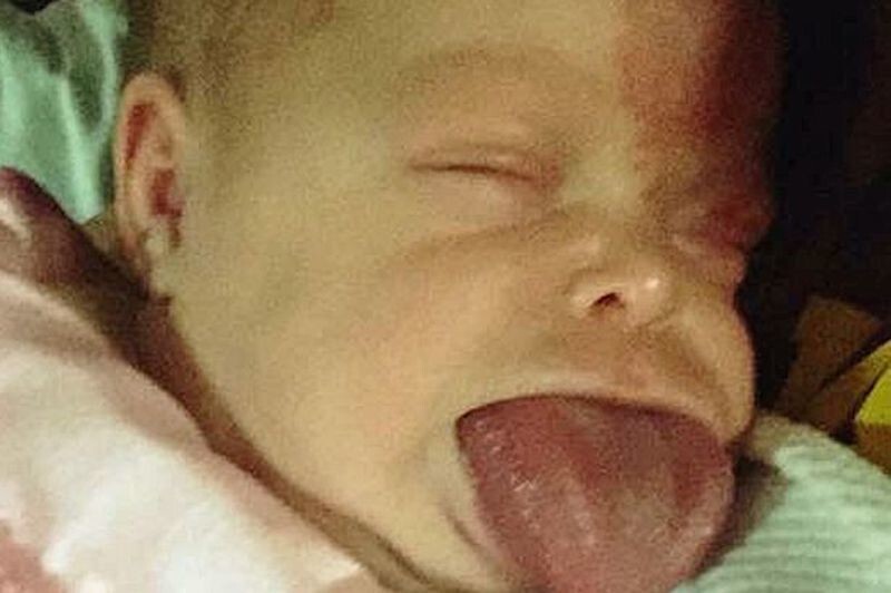 Малышка, родившаяся с огромным языком, наконец-то может улыбаться