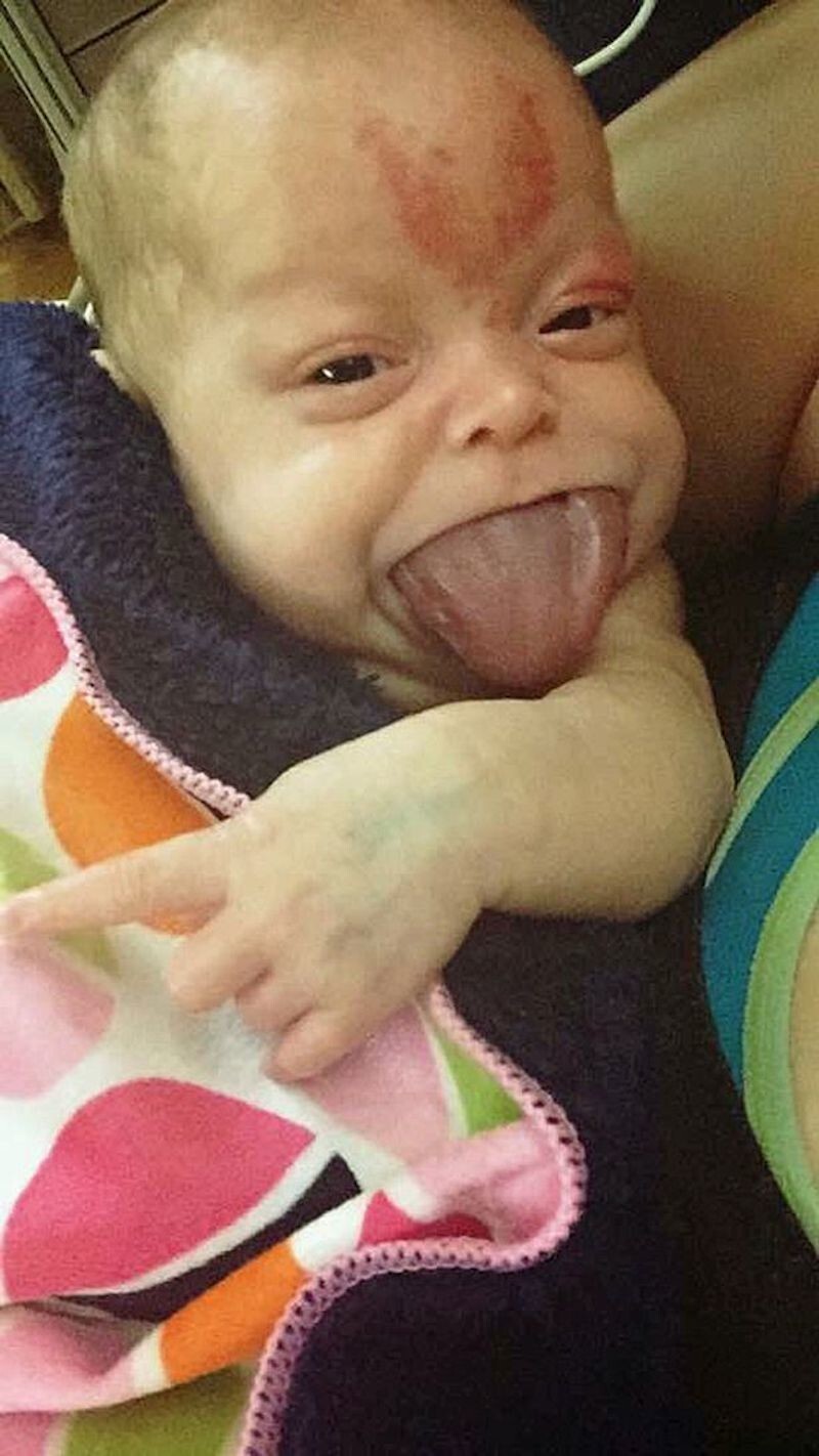 Малышка, родившаяся с огромным языком, наконец-то может улыбаться