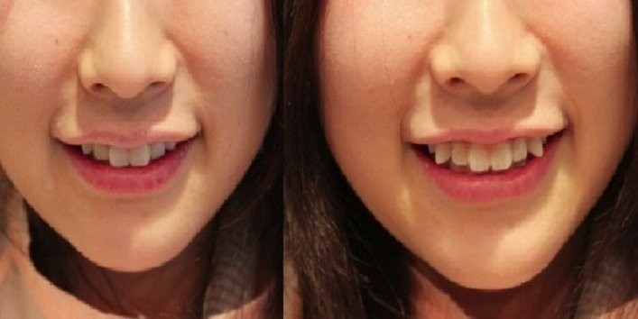3. Некоторые японки специально искривляют зубы 