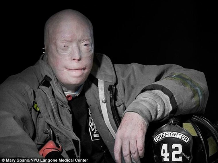 Патрик Хардисон после 71 одной пластической операции в течении 14 лет