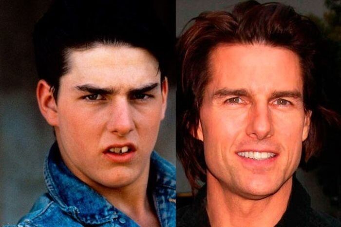4.Том Круз до и после выравнивания зубов.