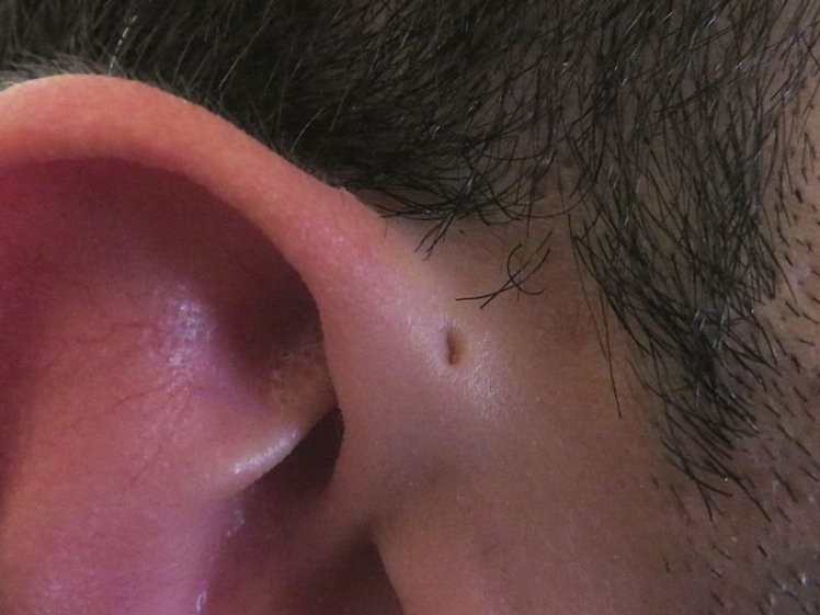 Вот почему некоторые люди рождаются с крошечным отверстием возле ушей