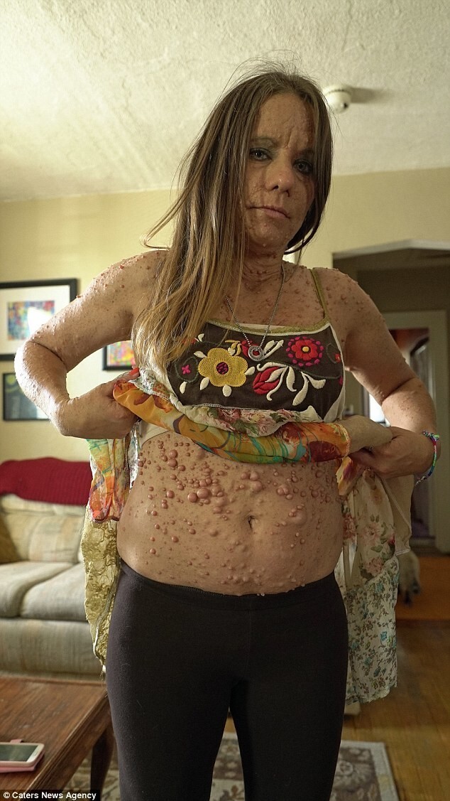 «Все, что я хочу — быть обожаемой»: Женщина пытается избавиться от 6 тысяч опухолей