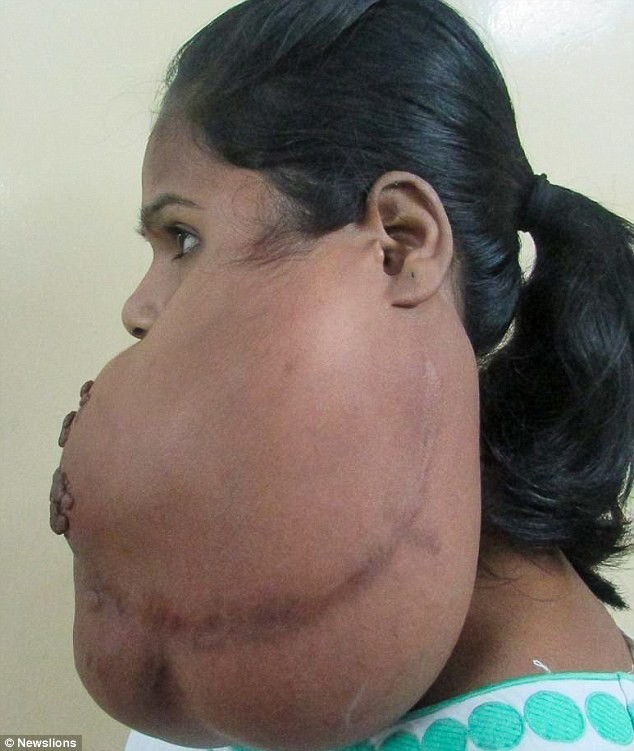 Индийская девочка улыбнулась впервые за 14 лет после того, как хирурги удалили опухоль с ее лица