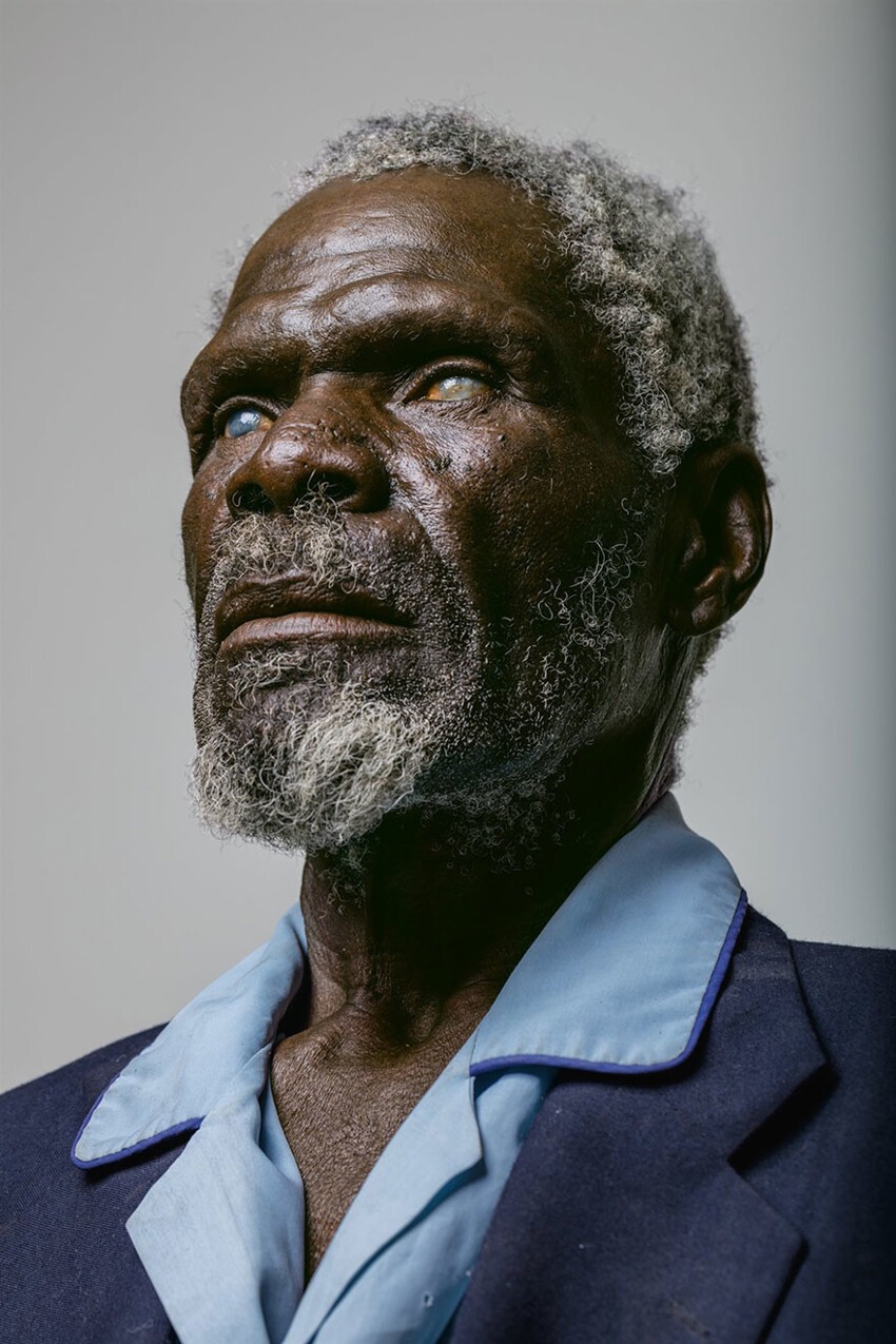 30. 67-летний Герд Гаманаб из Намибии, годы труда на солнце и пыль уничтожили роговицу его глаз.