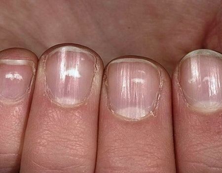 О чем расскажут ваши ногти,  диагностика заболеваний