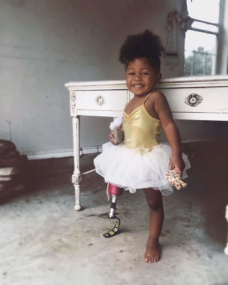 Аврора Каиро — очаровательная 2-летняя малышка с протезом ноги