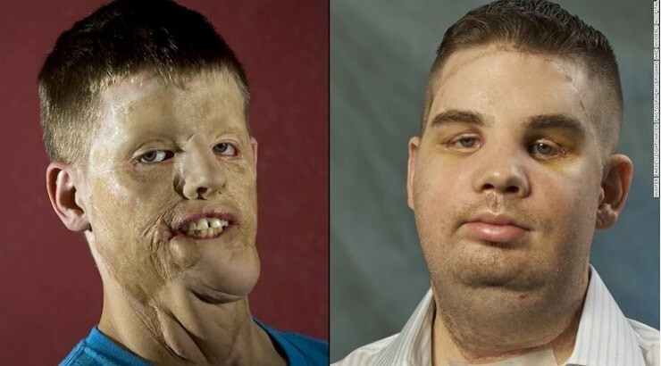 Это напоминает историю о трансплантации другого человека - Митчелла Хантера. Спустя пять лет после операции он выглядит отлично.