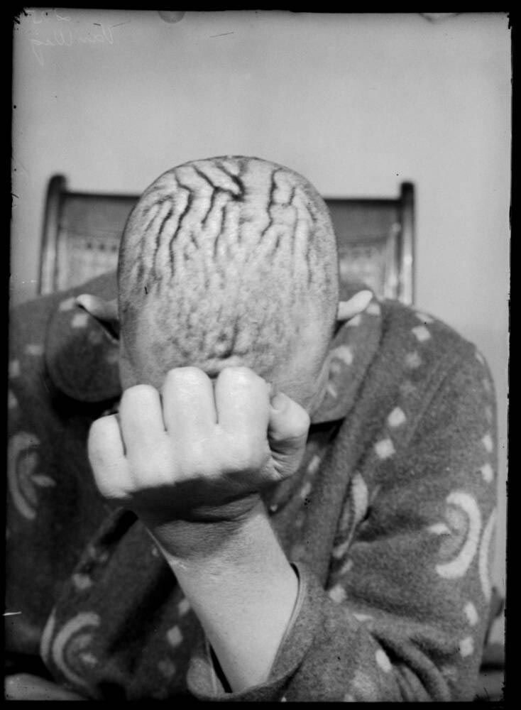 Обнаружены фотографии пациентов, которые перенесли одни из первых операций на мозге