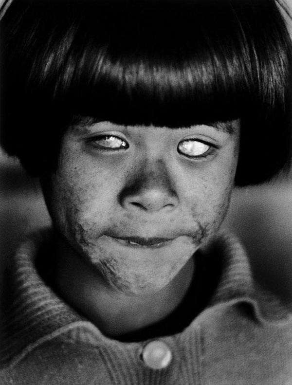 Ребенок, потерявший зрение после атаки на Хиросиму, 1945 г.